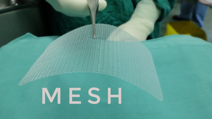 Hernia mesh attorneys near me